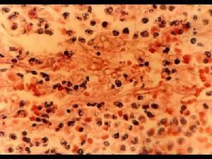 革蘭陰性桿菌敗血症