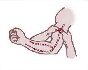 神經止血帶 神經止血帶