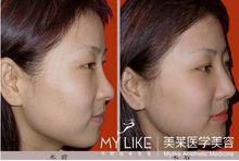 黃金龍隆鼻案例