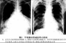 甲狀腺機能減退症 心包積液
