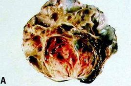 Sertoli-Leydig細胞瘤 Sertoli-Leydig細胞瘤