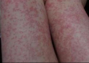 兒童過敏 兒童過敏