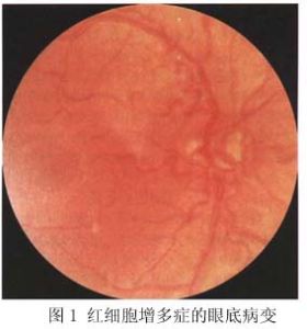 紅細胞增多症眼底