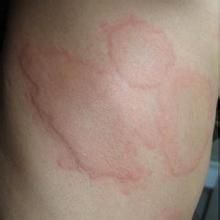 過敏性尋麻疹 過敏性尋麻疹