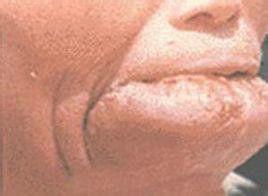 舌澱粉樣變性 舌澱粉樣變性