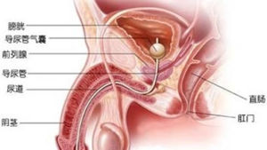 先天性尿道下裂 先天性尿道下裂
