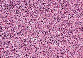 惡性組織細胞病 惡性組織細胞病