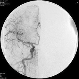 介入放射學 介入放射學