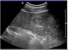 肝局灶性結節性增生