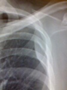 胸膜間皮瘤 胸膜間皮瘤