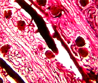 腎血管畸形與壓迫