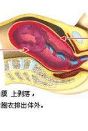 宮縮乏力 宮縮乏力
