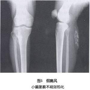 鹼性磷酸鈣結晶沉積病 鹼性磷酸鈣結晶沉積病