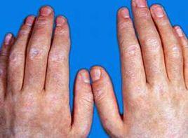 肢端硬化 肢端硬化