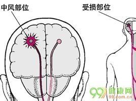 腦中風后遺症 腦中風后遺症