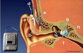 人工耳蝸技術 人工耳蝸技術