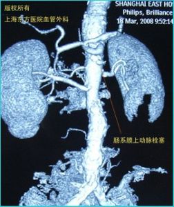 腸系膜動脈栓塞