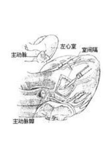 主動脈狹窄 主動脈狹窄