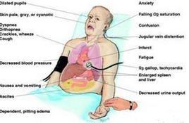 急性右心衰竭 急性右心衰竭