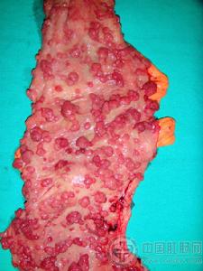 家族性腺瘤性息肉病 家族性腺瘤性息肉病