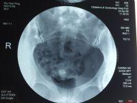 碘過敏試驗 碘過敏試驗