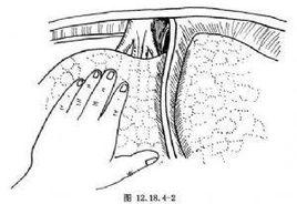 右三葉肝切除術 右三葉肝切除術