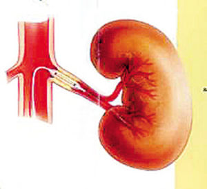 隱匿性腎病 隱匿性腎病