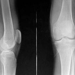 絨毛結節性滑膜炎 絨毛結節性滑膜炎