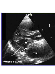 小兒感染性心內膜炎 小兒感染性心內膜炎