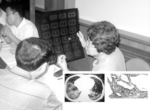 非特異性間質性肺炎