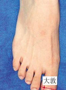 大敦穴 大敦穴