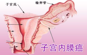 子宮內膜腫瘤 子宮內膜腫瘤
