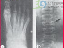 同型胱氨酸尿症