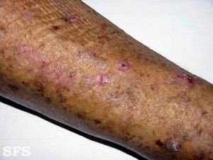 日光角化病 日光角化病