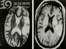 顱腦損傷伴發精神障礙