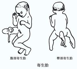 胎中胎[寄生胎]