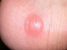 紅細胞生成性卟啉病 紅細胞生成性卟啉病