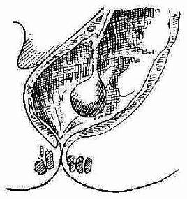 兒童直腸息肉 兒童直腸息肉