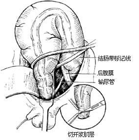 阿米巴病腸穿孔 阿米巴病腸穿孔