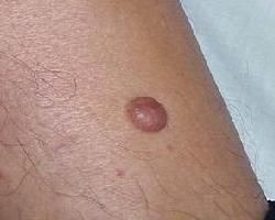 隆突性皮膚纖維肉瘤 隆突性皮膚纖維肉瘤