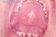 口腔黏膜白斑 