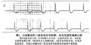 完全性房室傳導阻滯