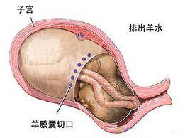 胎膜羊水 胎膜羊水
