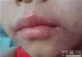 光線性唇炎 光線性唇炎
