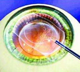 ICL晶體植入 ICL晶體植入