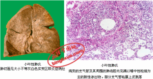小葉性肺炎
