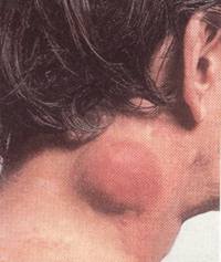 愛滋病性頸淋巴結腫大