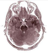 磁共振成像掃描人類大腦