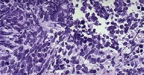 肝性卟啉病 肝性卟啉病