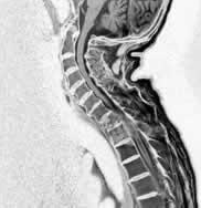 頸椎過伸性損傷 頸椎過伸性損傷